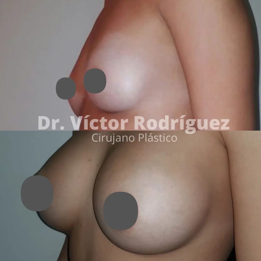 cirugia de aumento de senos