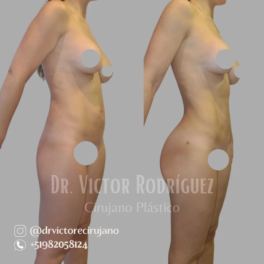 antes y después de una lipoescultura