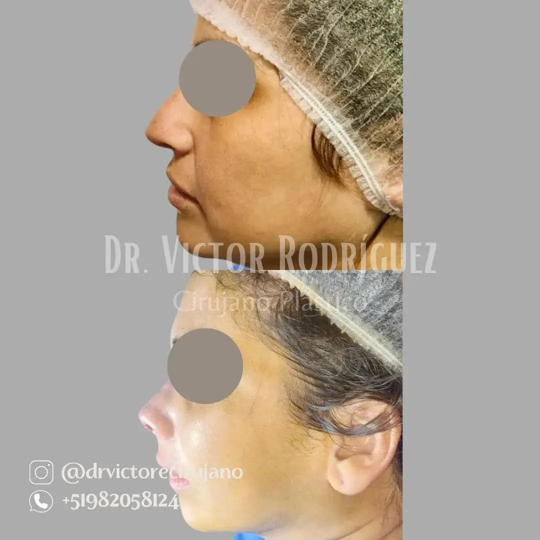 rinoplastia primaria con técnica cerrada